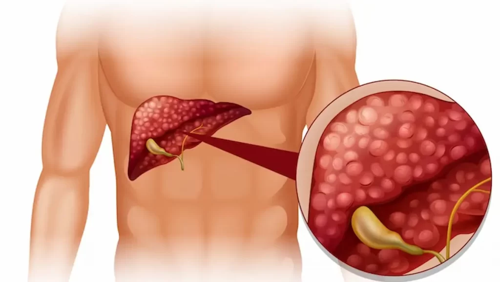 Best Liver Cancer Treatment in Chennai | CTS Hospitals