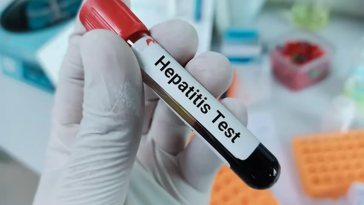 100% Best Treatment For Hepatitis C in Chennai | Expert Care