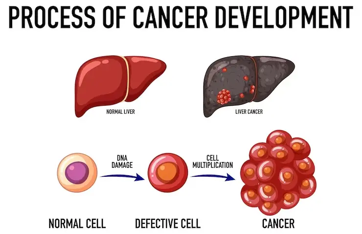 best liver cancer hospital in Chennai | CTS Hospitals