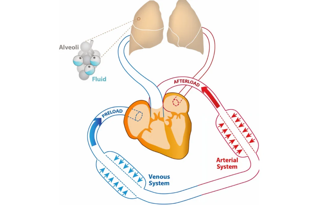 Hypertension Leading To Heart Failure