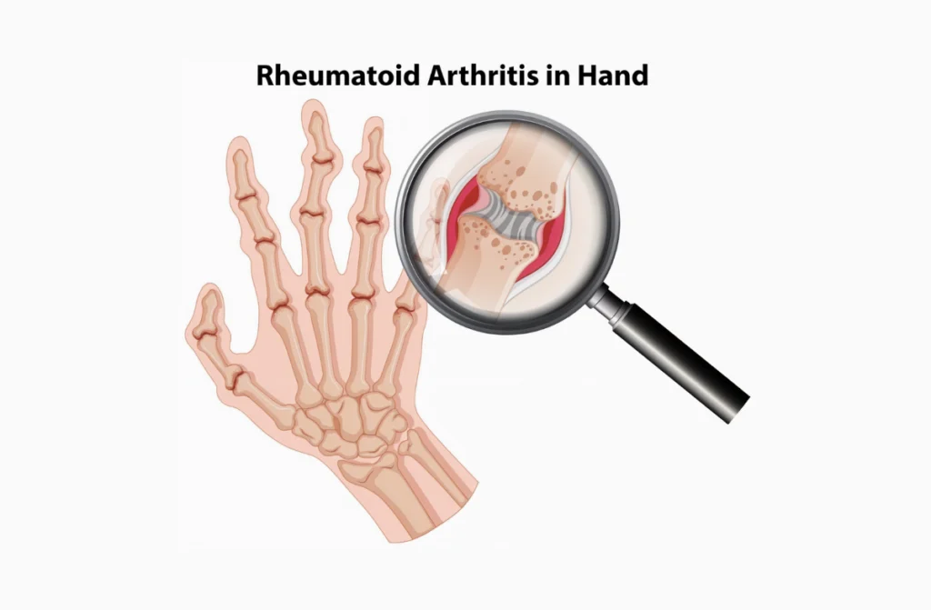 Best Treatment for Rheumatoid Arthritis