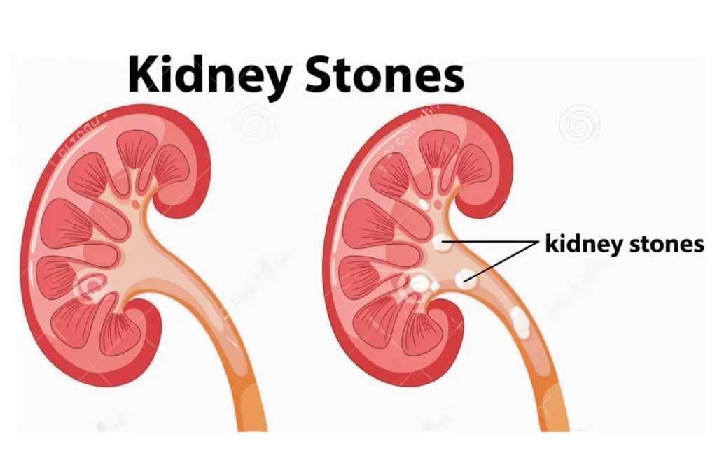 Nephrologist in Chennai