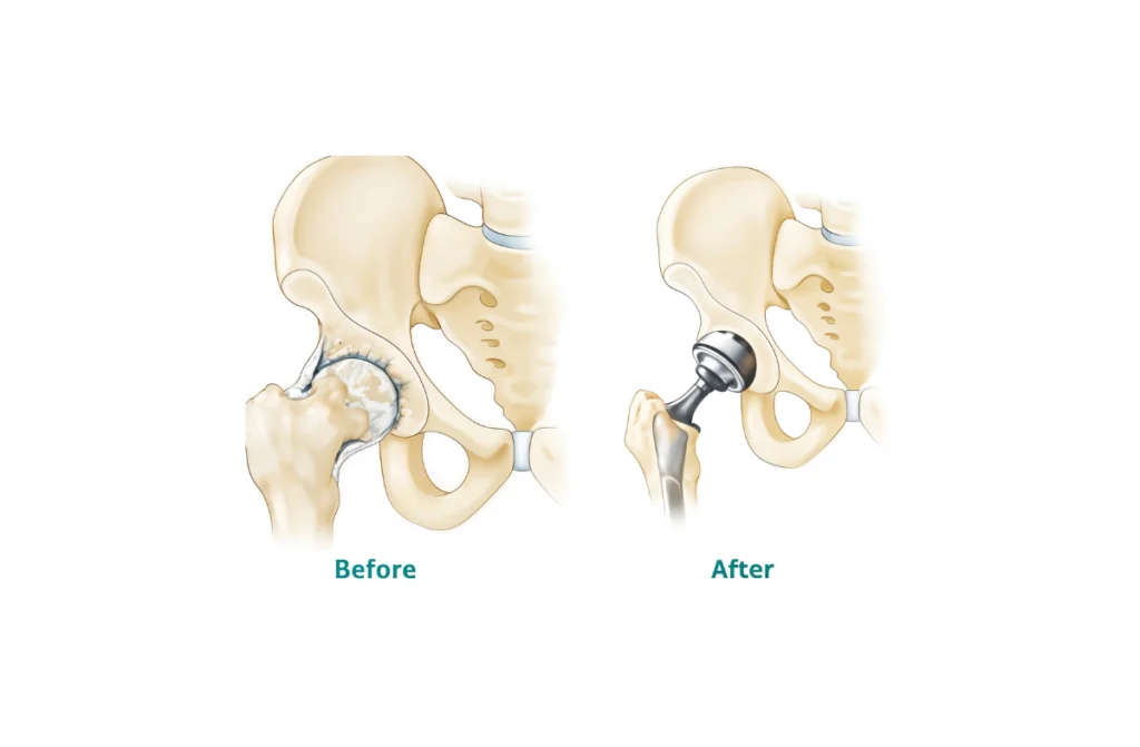 Hip Replacement Hospital in Chennai